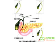 妊娠合并急性胆囊炎